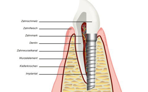 Zahnimplantat / Implantologie