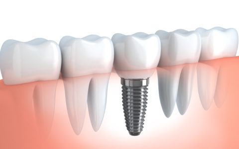 Menschliches Zahnimplantat (in 3D-Grafiken)