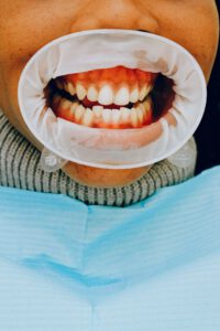 Zähne mit Zahnfleischtaschen