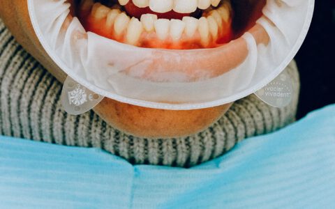 Zähne mit Zahnfleischtaschen