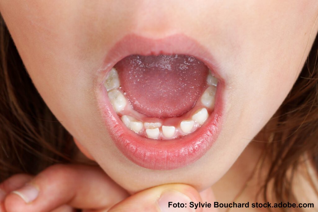 Durchbruch der Erwachsenen Zähne im Mund