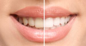 Lächelnde Frau vor und nach der Zahnaufhellung, Nahaufnahme