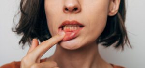 Nahaufnahme einer Zahnfleischentzündung. Ausschnitt einer jungen Frau mit rot blutendem Zahnfleisch isoliert auf grauem Hintergrund.