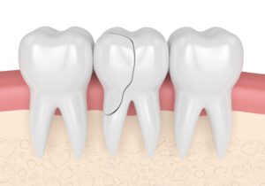 3d Rendering von Zahnfleisch mit gebrochenem Zahn