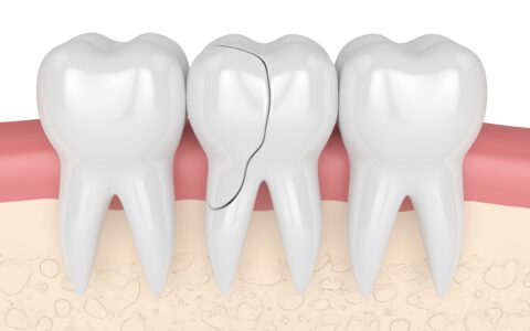 3d Rendering von Zahnfleisch mit gebrochenem Zahn