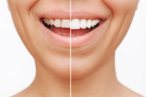 veneers vorher nachher